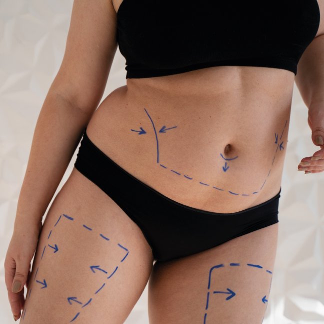Liposuction