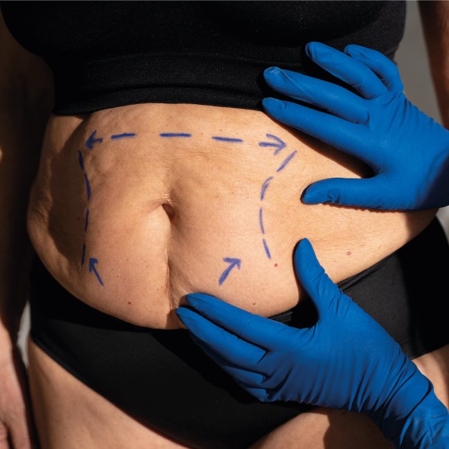 Tummy Tuck (Abdominoplasty)